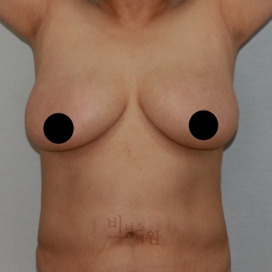 가슴지방흡입.jpg