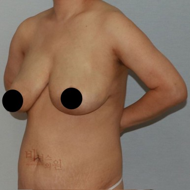 가슴축소지방흡입.jpg