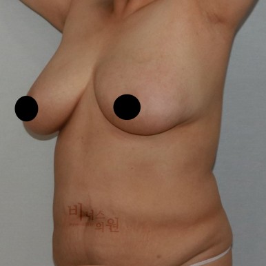 가슴축소지방흡입.jpg