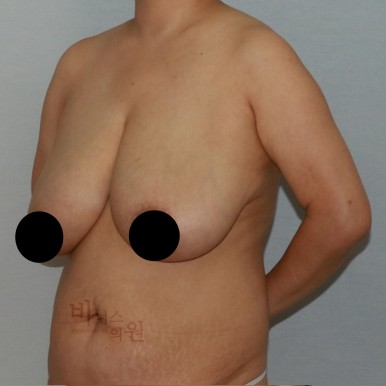 가슴축소지방흡입.jpg