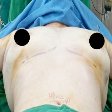 지방흡입 전후사진.jpg
