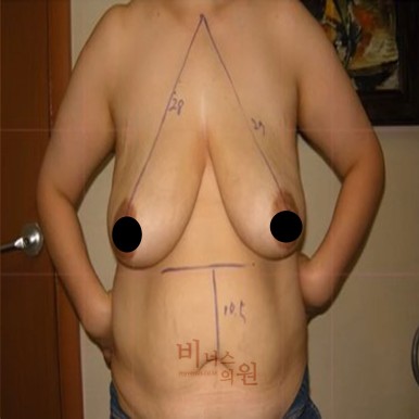 가슴 리프팅 사진.jpg