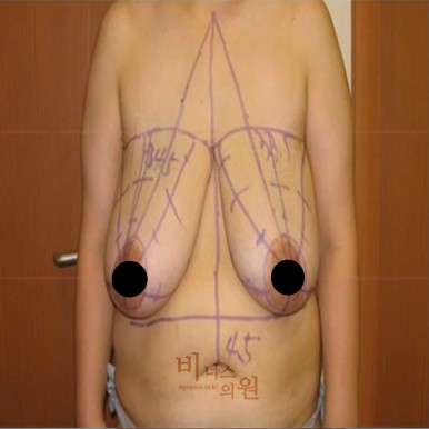가슴 리프팅 전후 사진.jpg