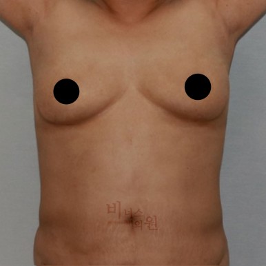 가슴지방흡입.jpg