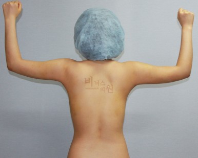 팔뚝지방흡입 전후 사진.jpg