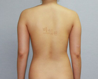 팔뚝지방흡입 효과.jpg