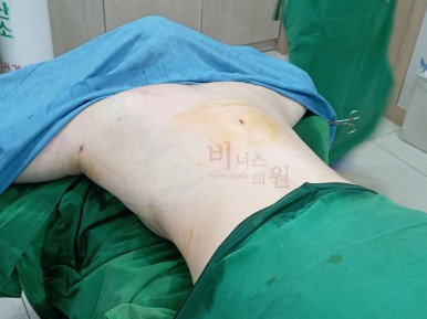 등 지방흡입.jpg