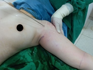 팔뚝지방흡입후기.jpg