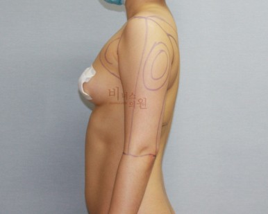 지방흡입 전후사진.jpg