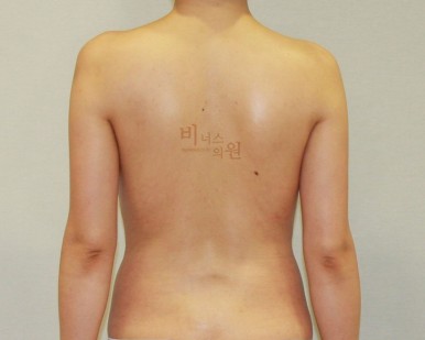 팔뚝지방흡입.jpg