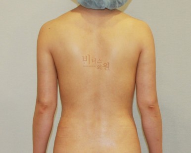 팔뚝 살 지방흡입.jpg