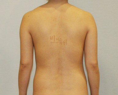 팔뚝 살 지방흡입.jpg