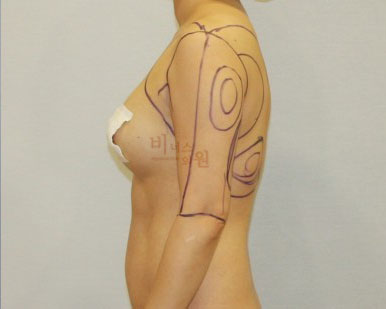 지방흡입 전후사진.jpg