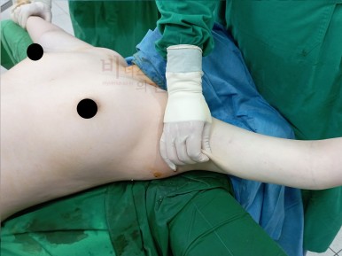 팔뚝지방흡입 전후.jpg