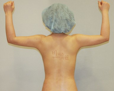 팔뚝살지방흡입.jpg