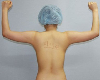팔뚝지방흡입.jpg