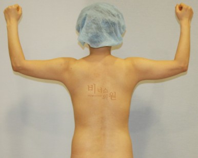 팔뚝 살 지방흡입.jpg