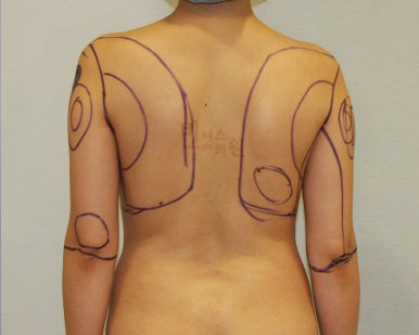 지방흡입 전후사진.jpg