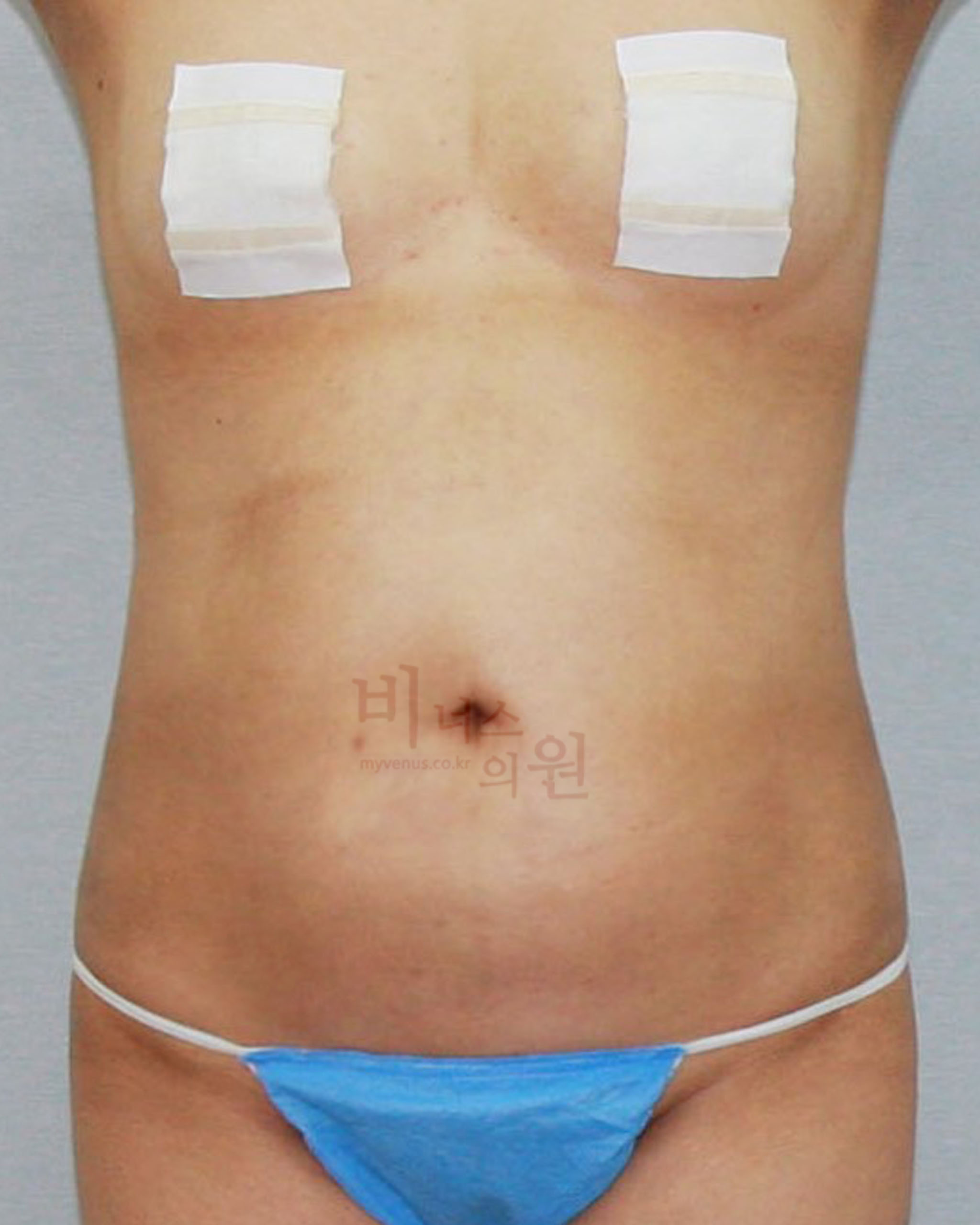 복부지방분해주사 지방흡입.jpg
