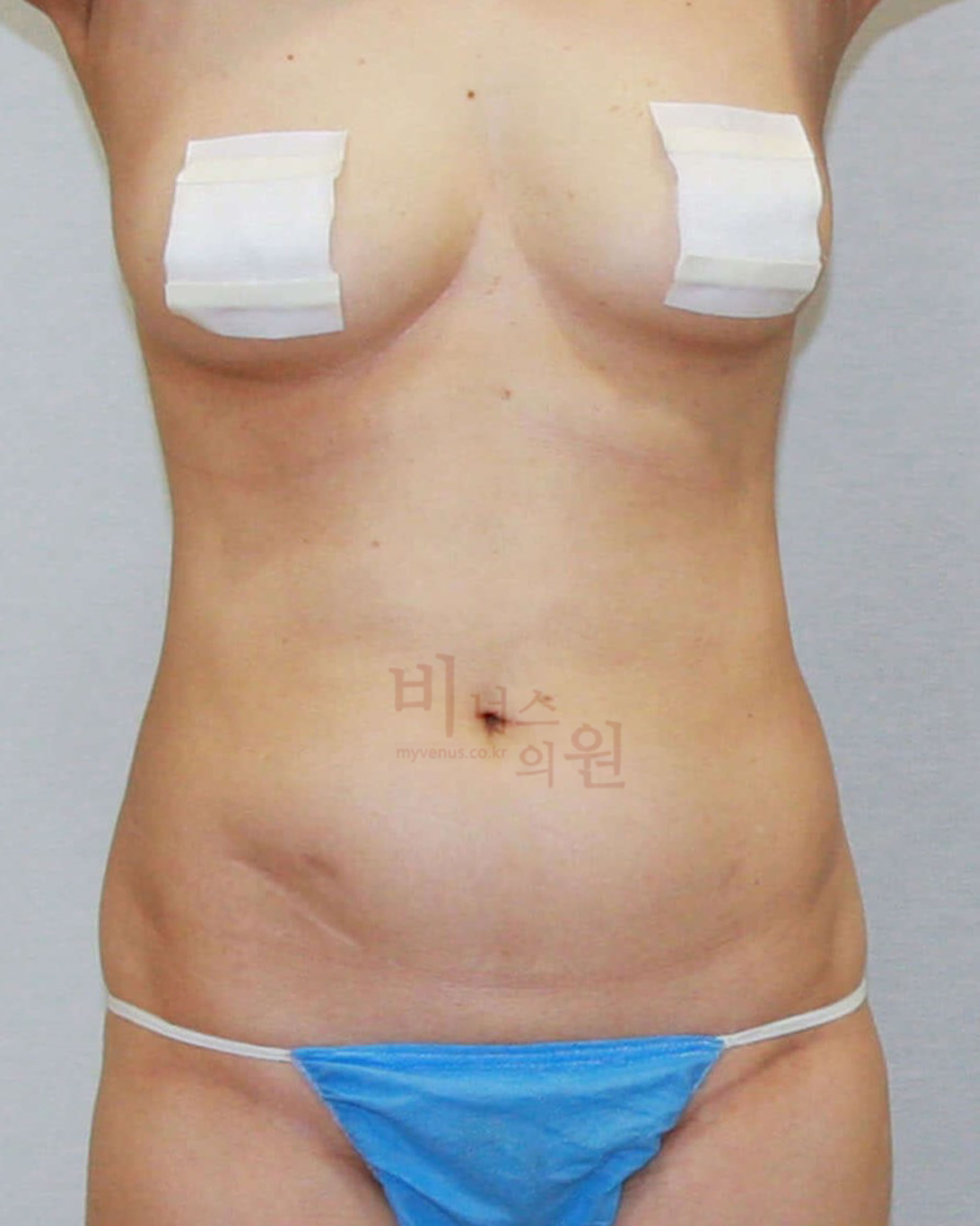 복부지방흡입.jpg