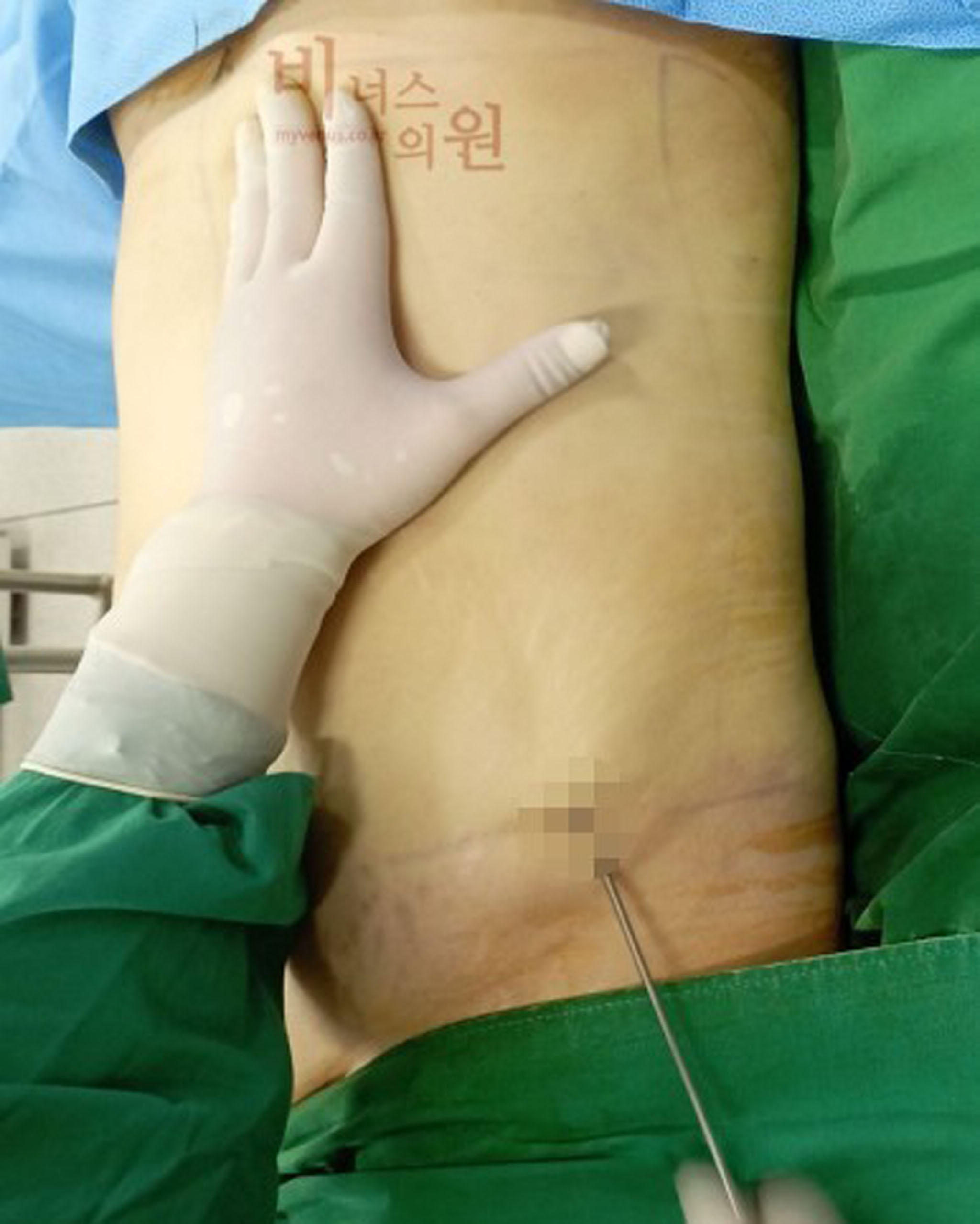 복부지방흡입 흉터.jpg