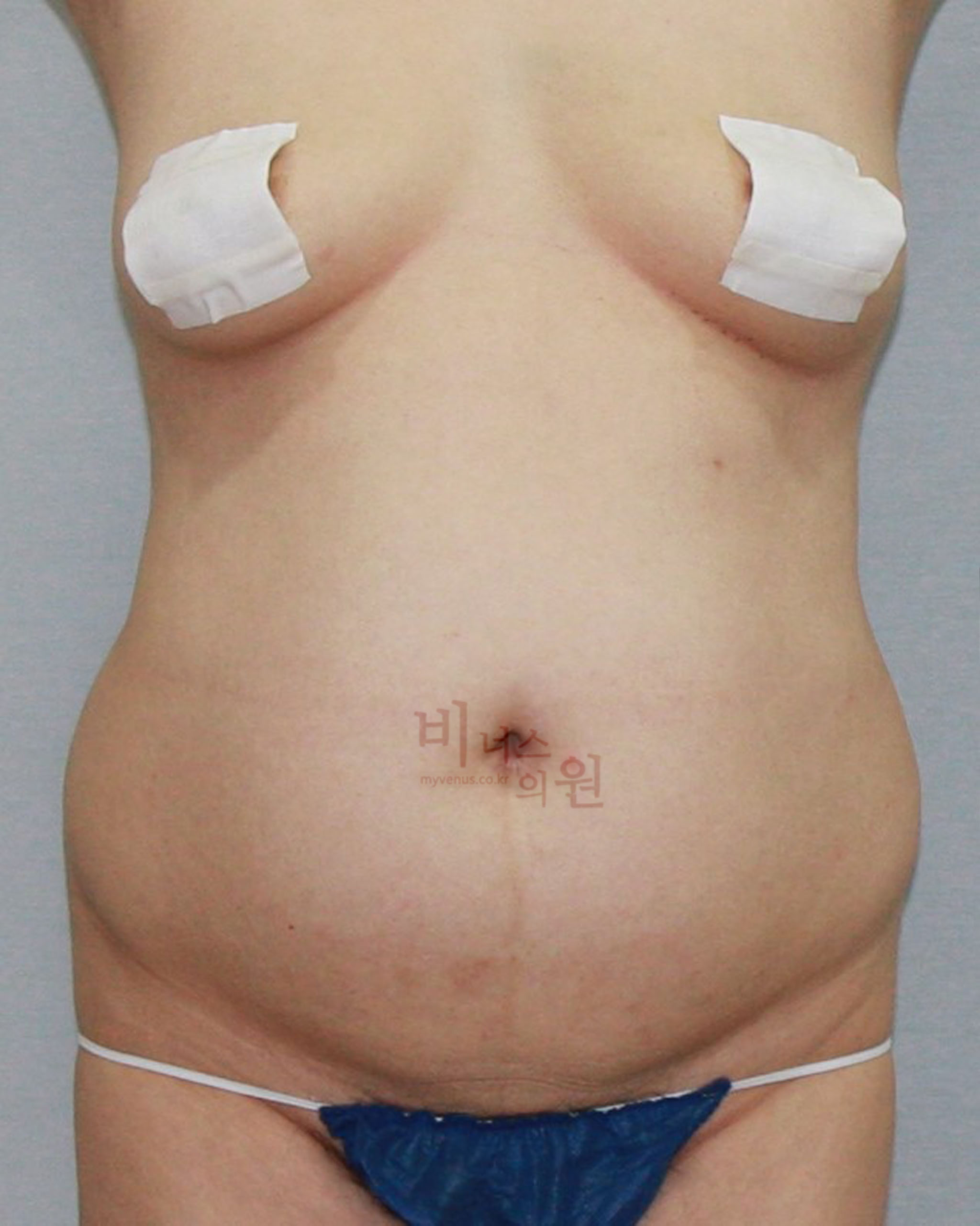복부지방흡입 일상생활.jpg