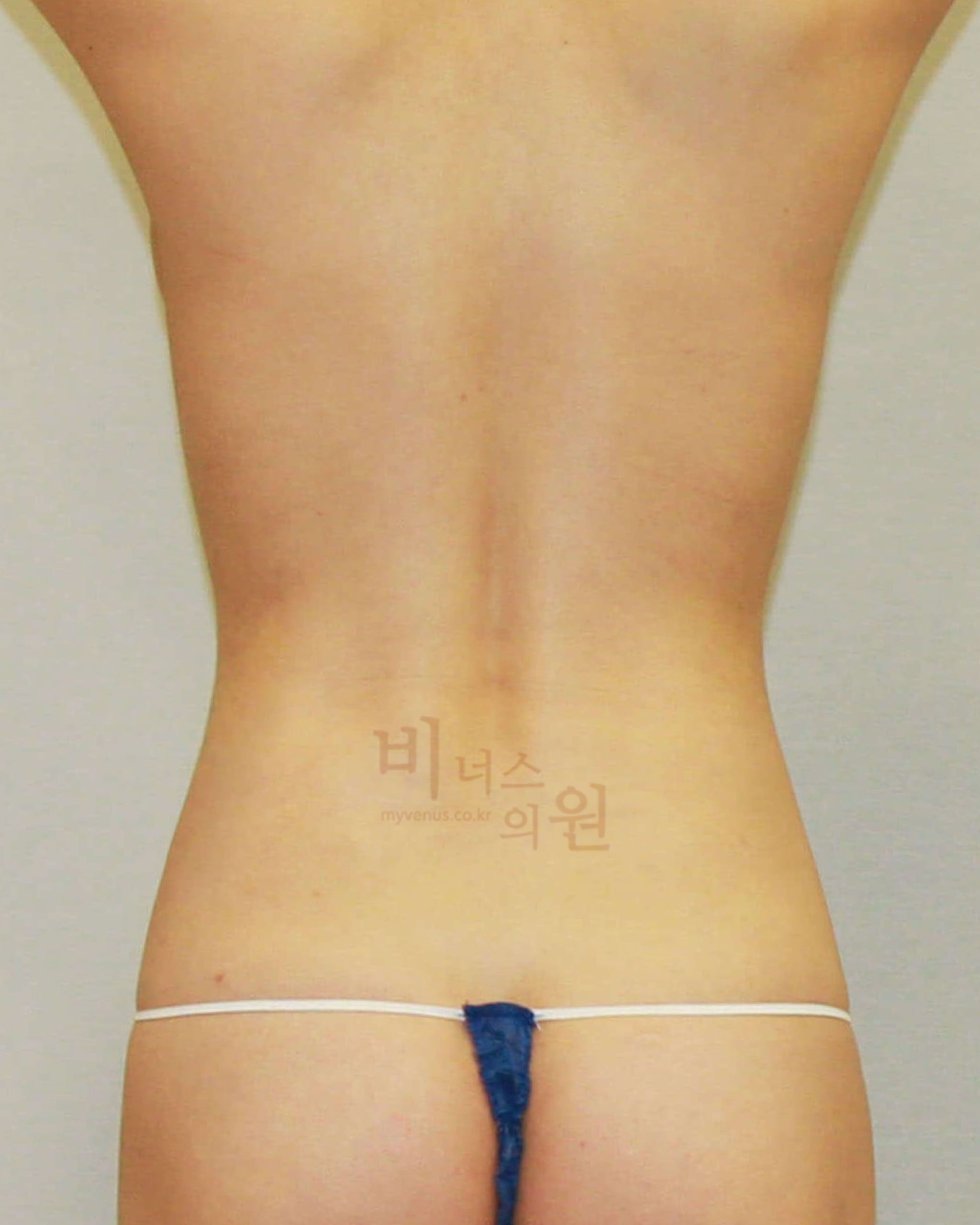 복부 옆구리지방흡입.jpg