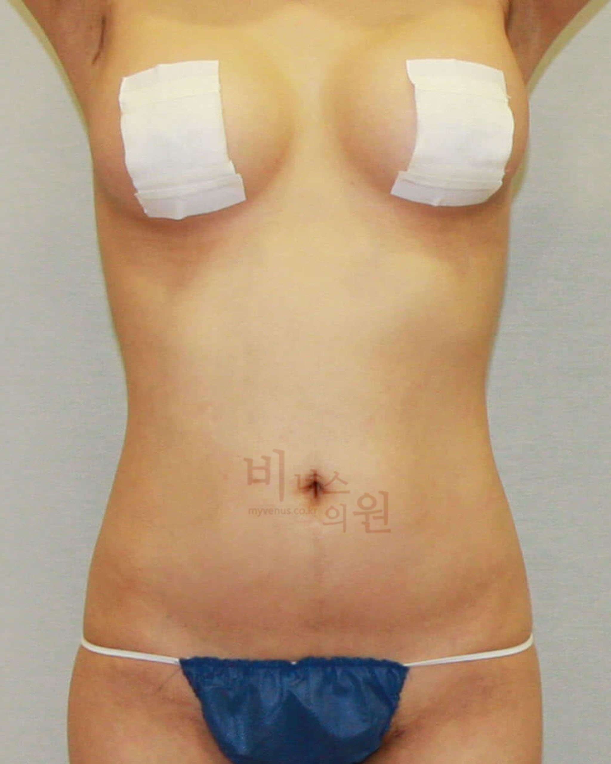 복부 옆구리지방흡입.jpg