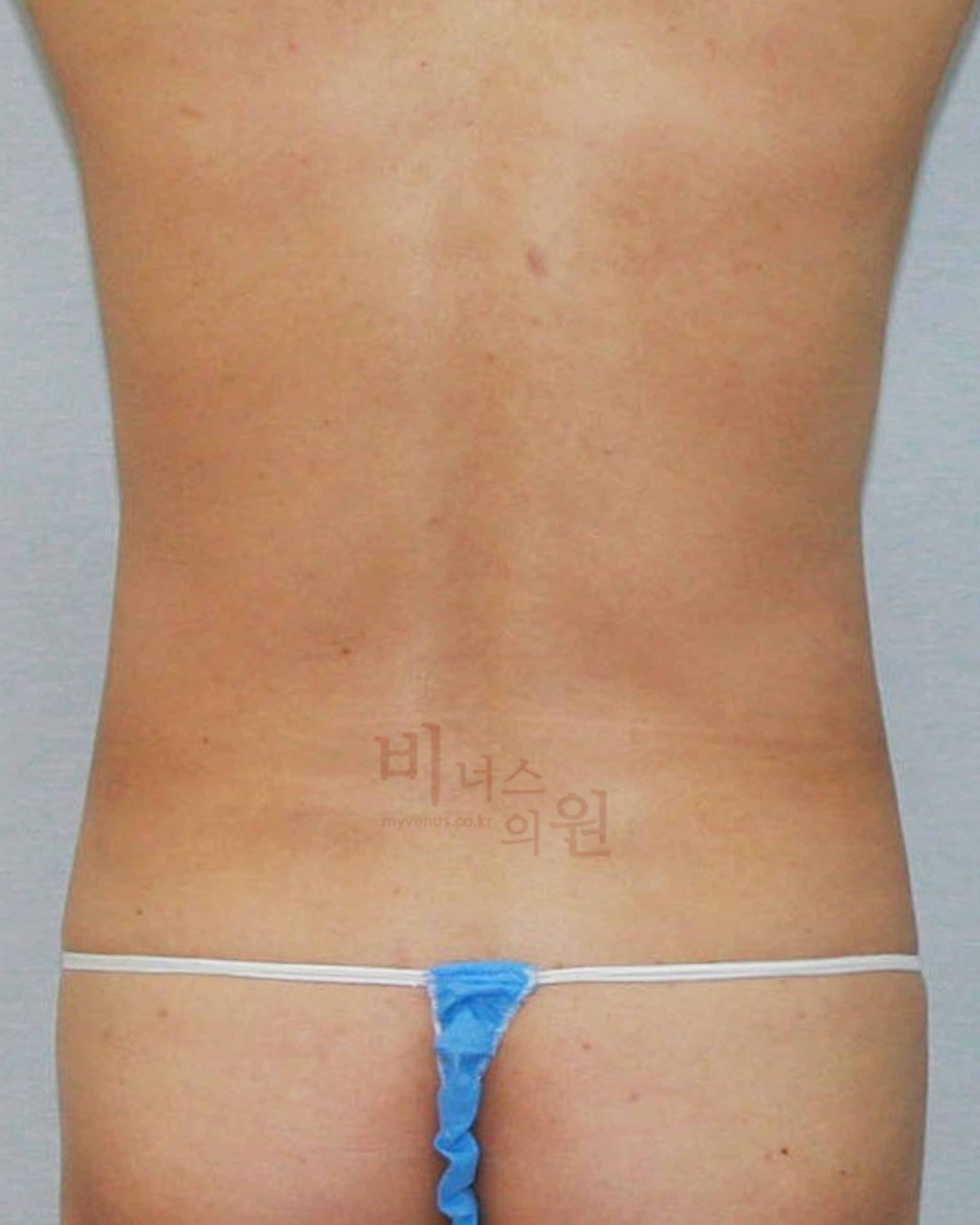 복부지방분해주사 지방흡입.jpg