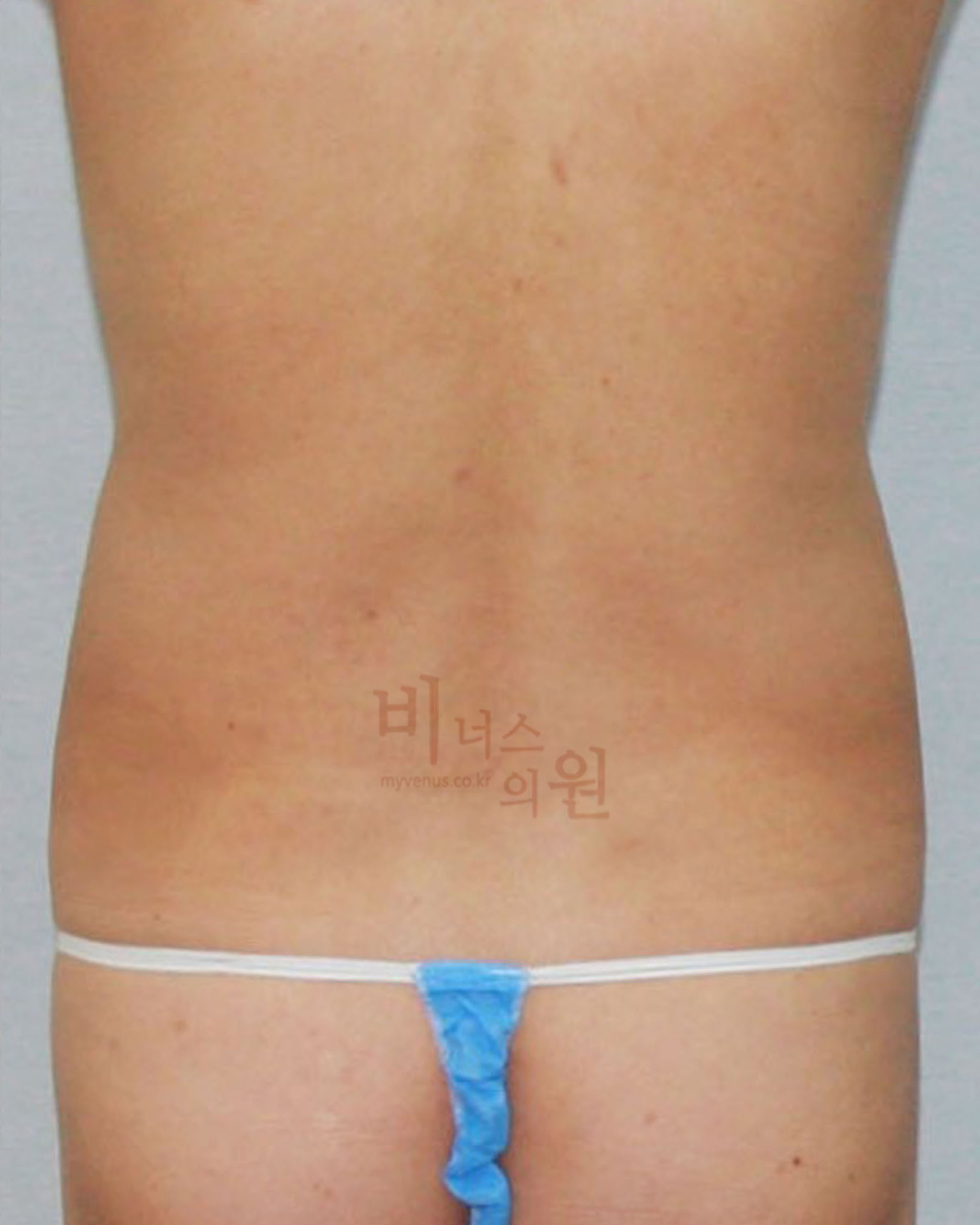 복부지방분해주사 지방흡입.jpg