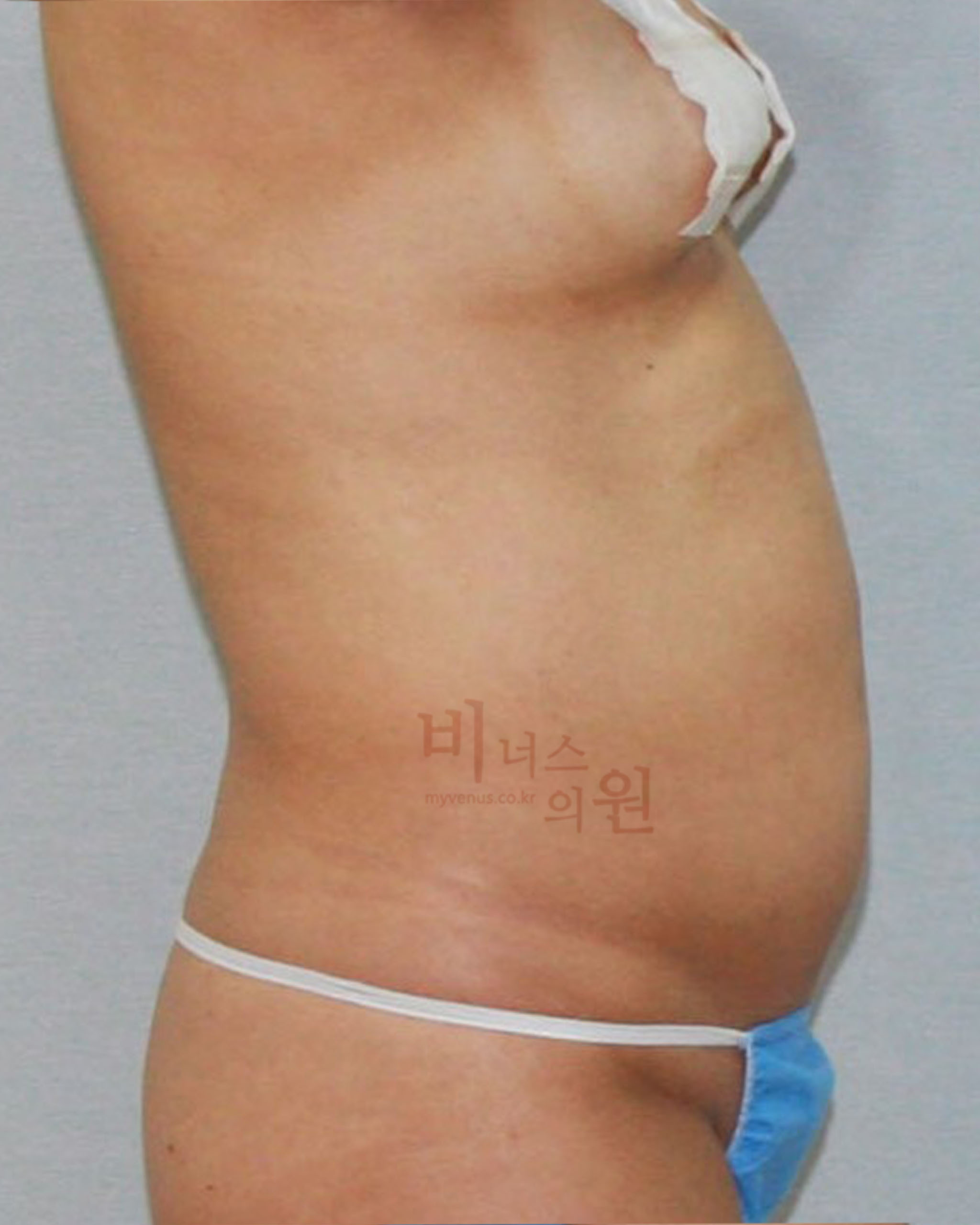 복부지방분해주사 지방흡입.jpg