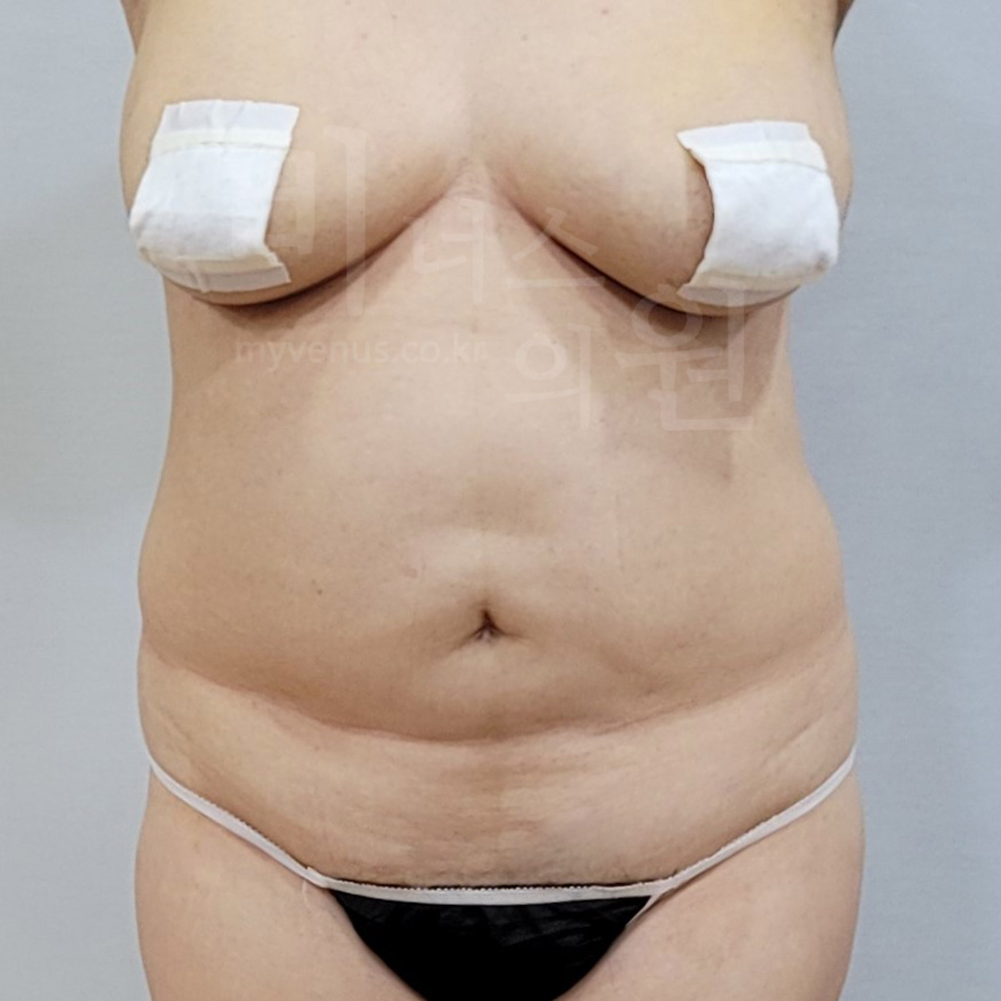 허리지방흡입.jpg