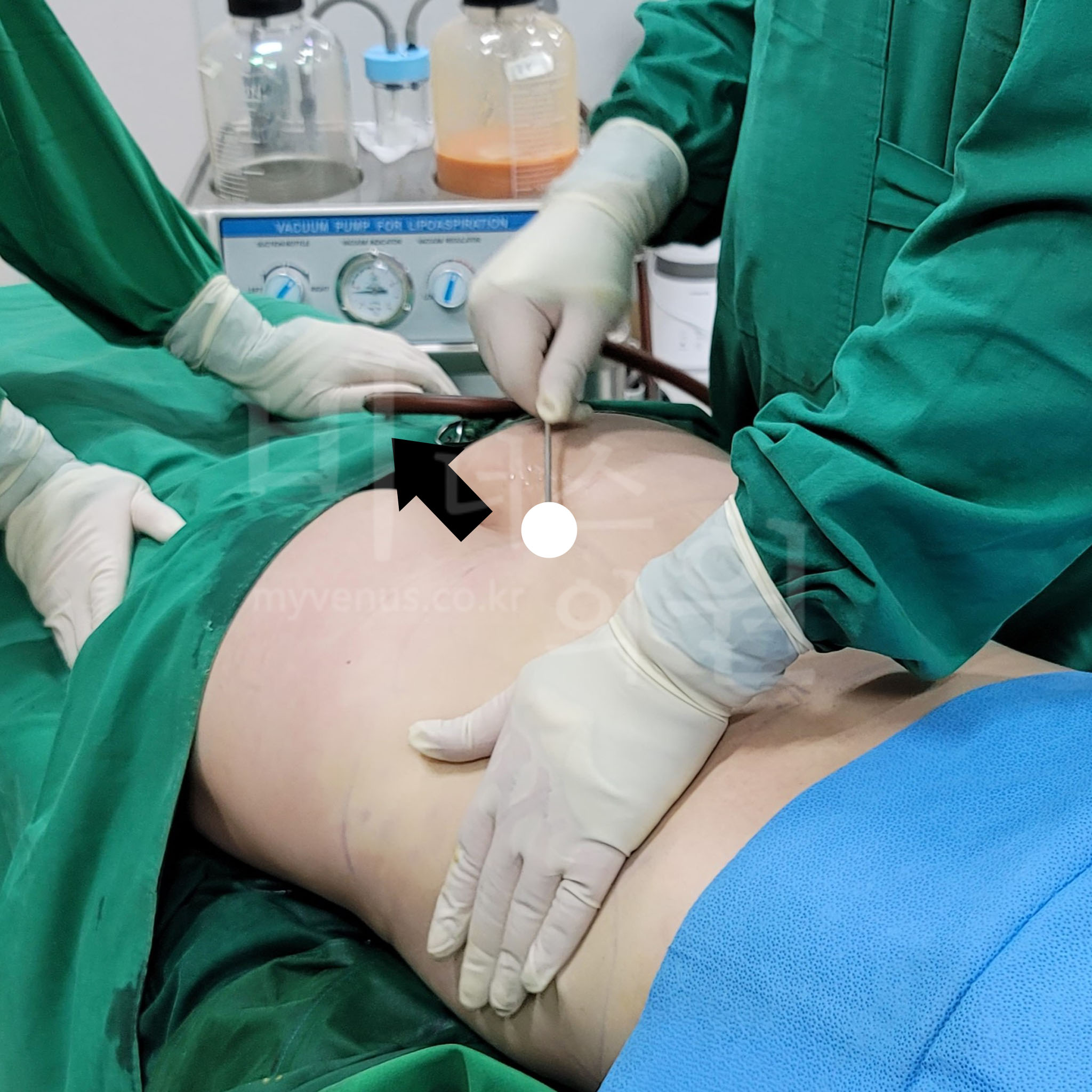 복 부지방 흡입.jpg