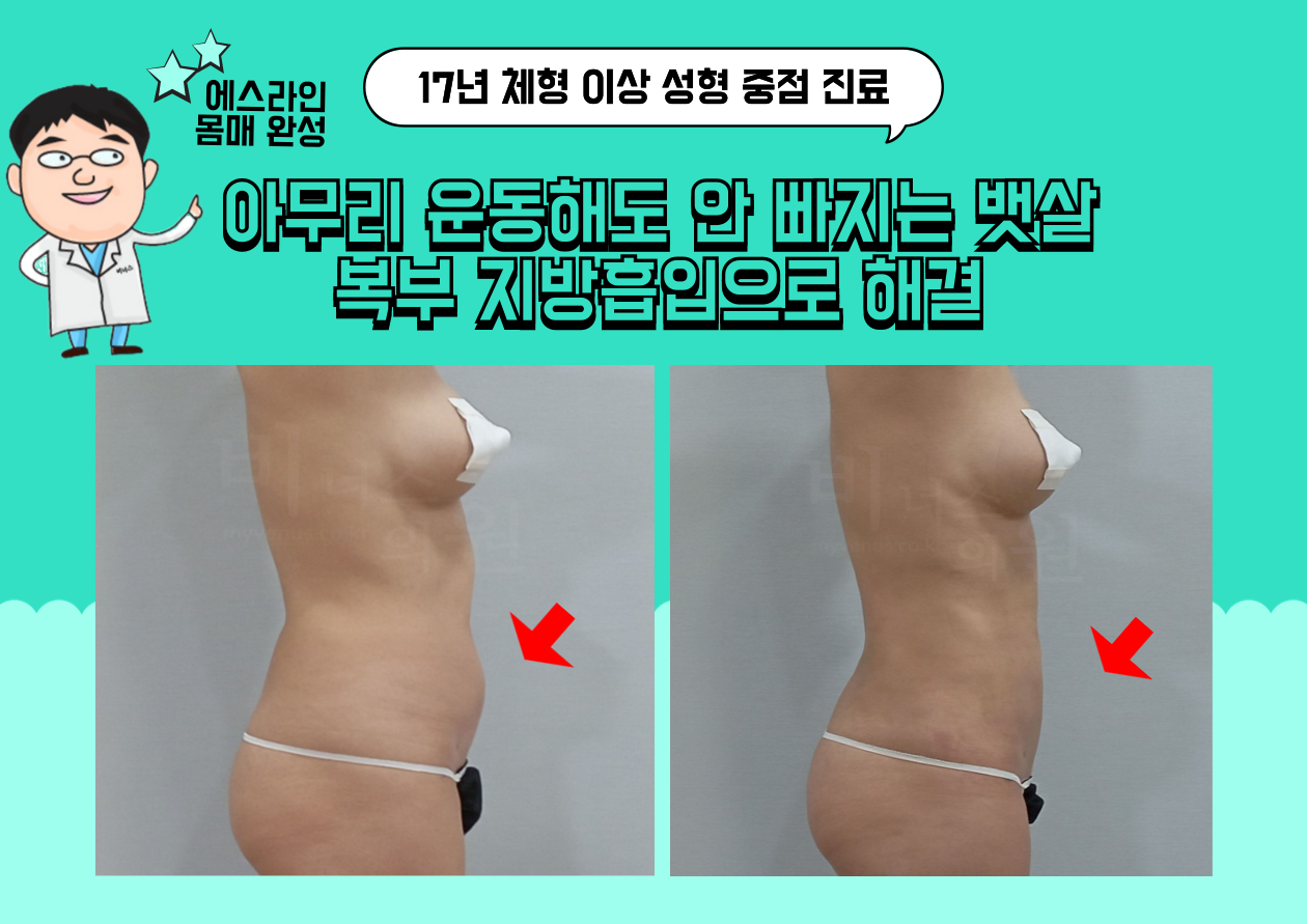 복부지방흡입.png