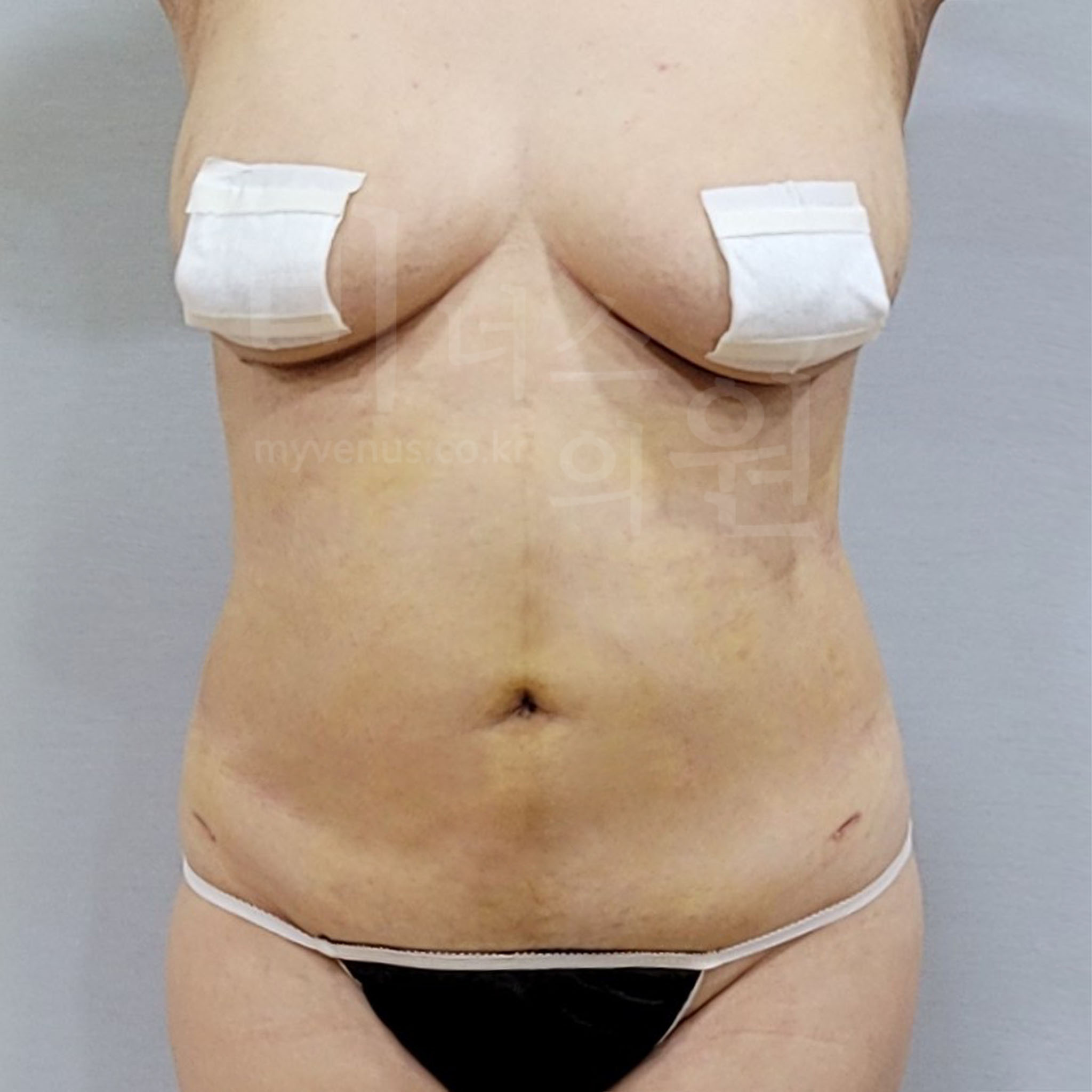 복부탄력.jpg
