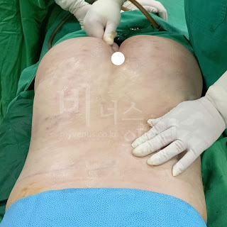 복부지방흡입후기.jpg
