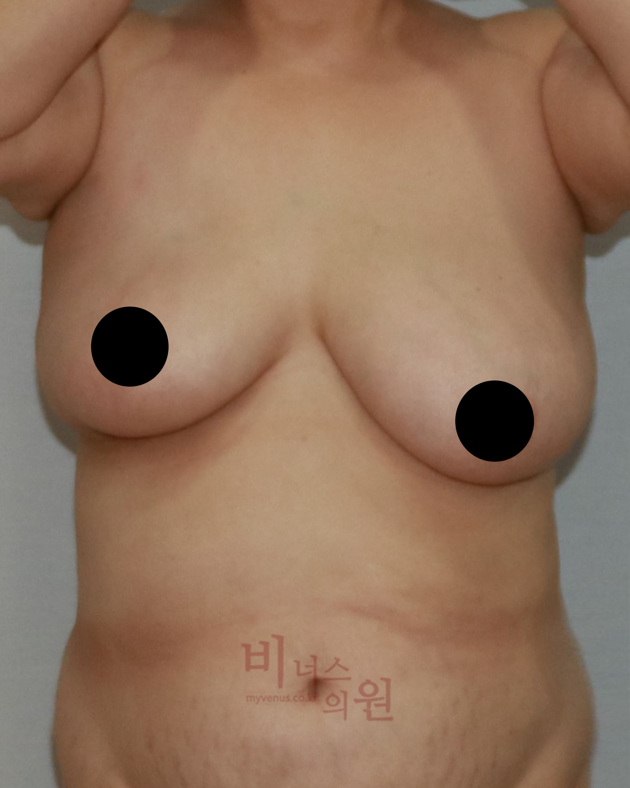가슴축소.jpg