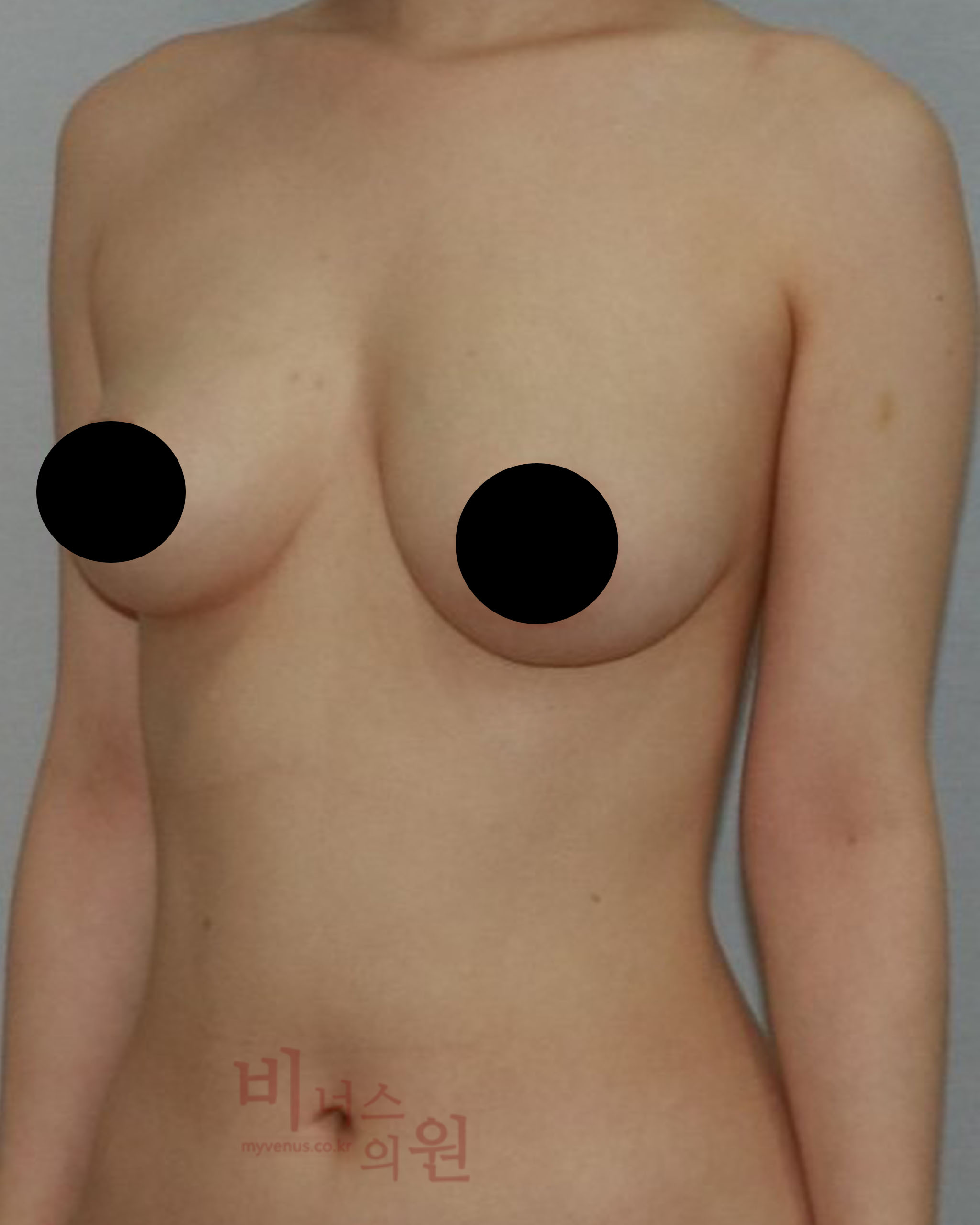 짝가슴 교정.jpg