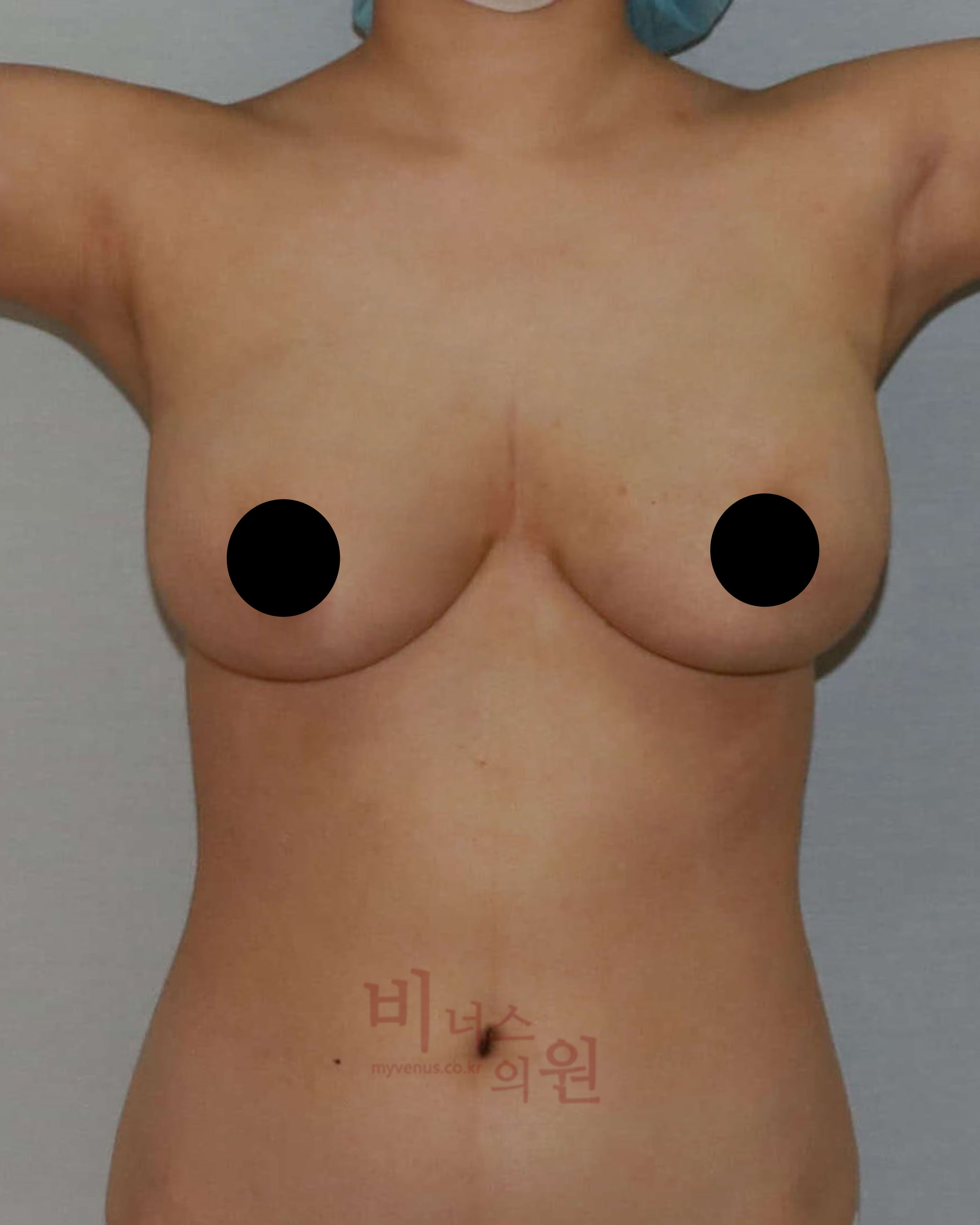 가슴지방흡입_짝가슴 교정.jpg