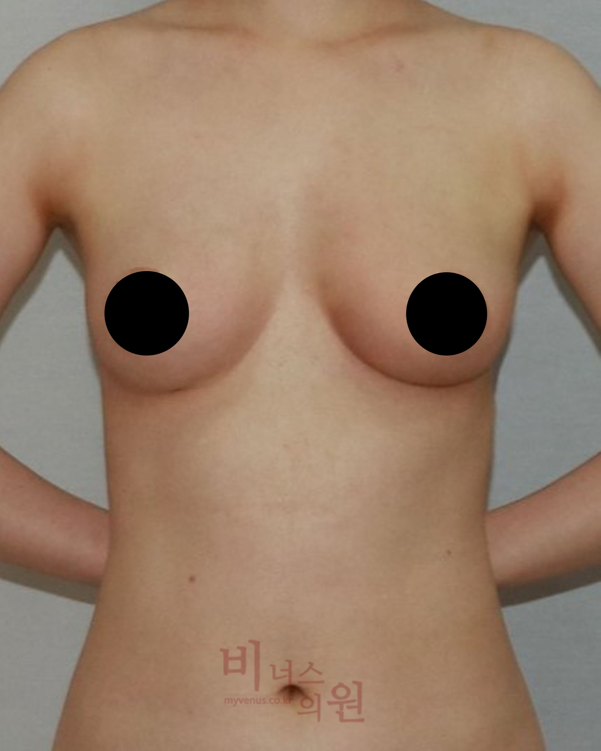 짝가슴 교정.jpg