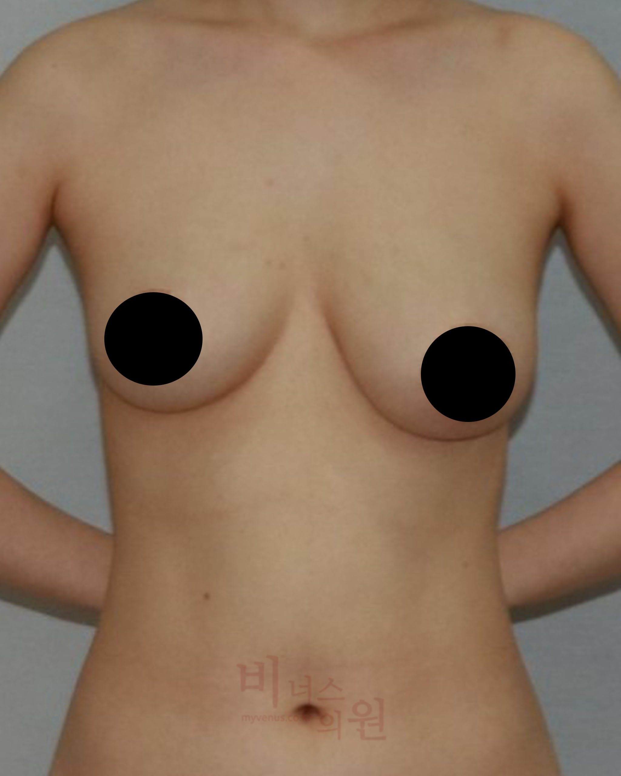 짝가슴 교정.jpg