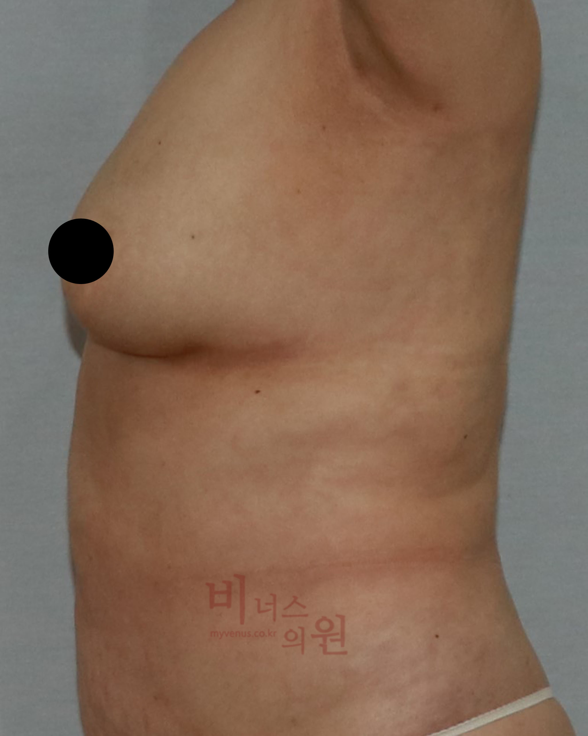 짝가슴 축소 지방흡입.jpg