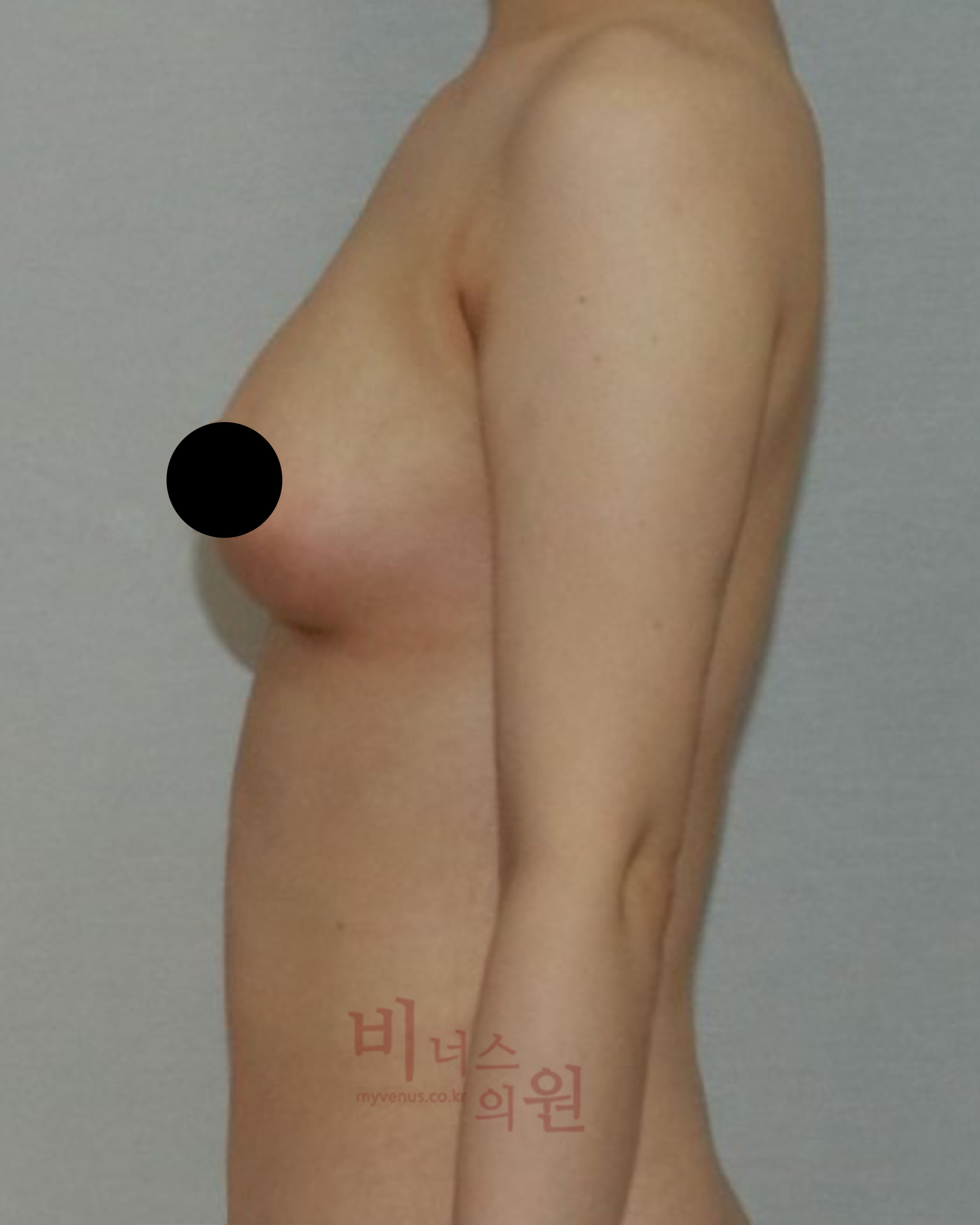 짝가슴 교정.jpg