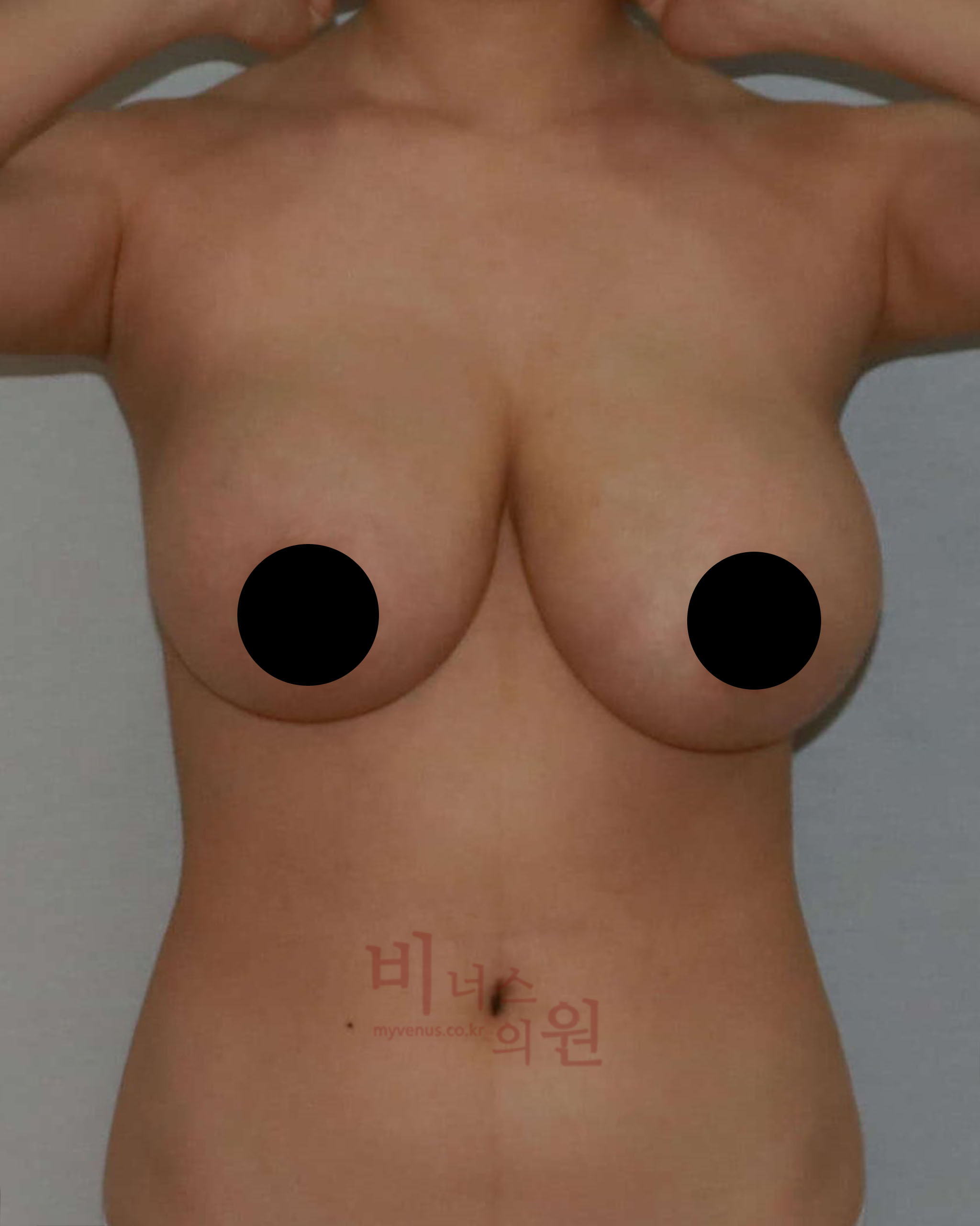 가슴지방흡입_ 짝가슴 교정.jpg