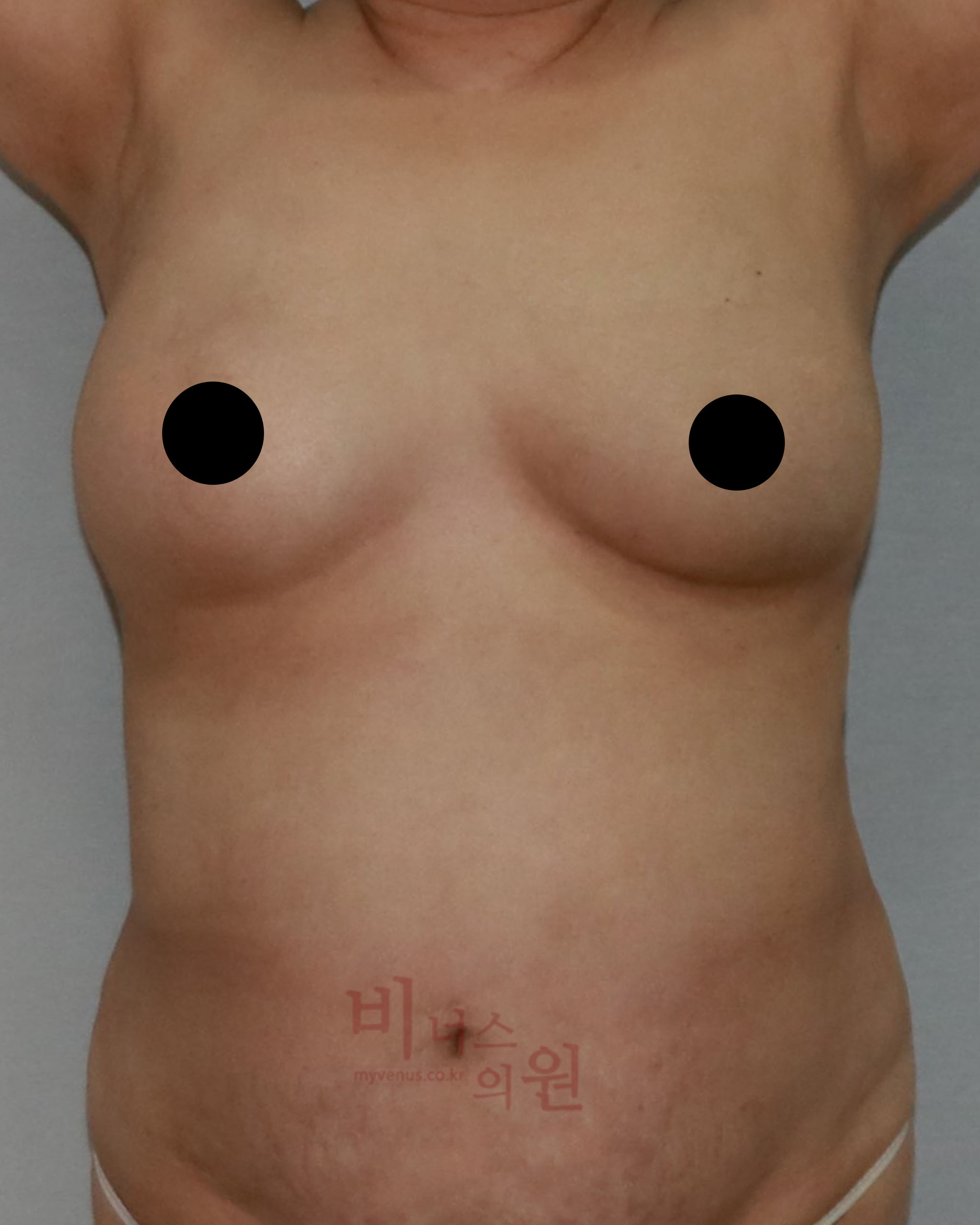 지방흡입 전후사진.jpg