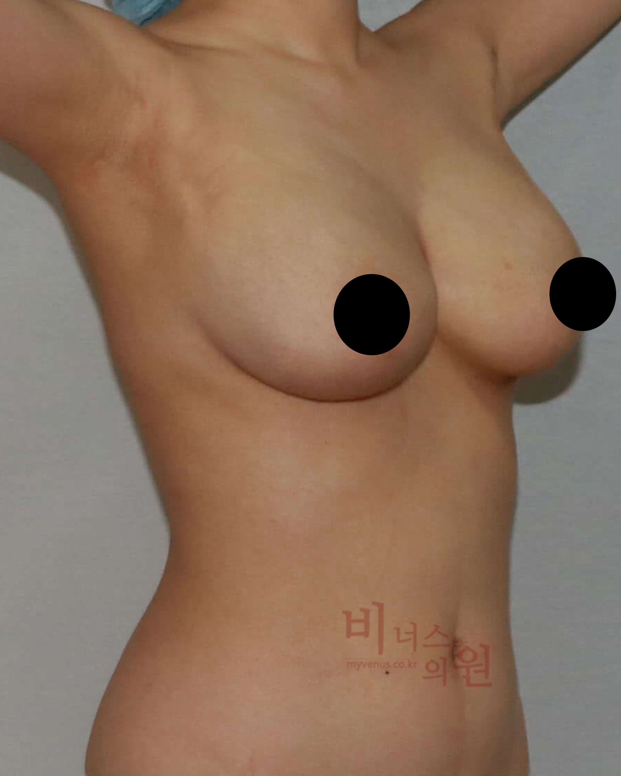 짝가슴 교정 지방흡입.jpg
