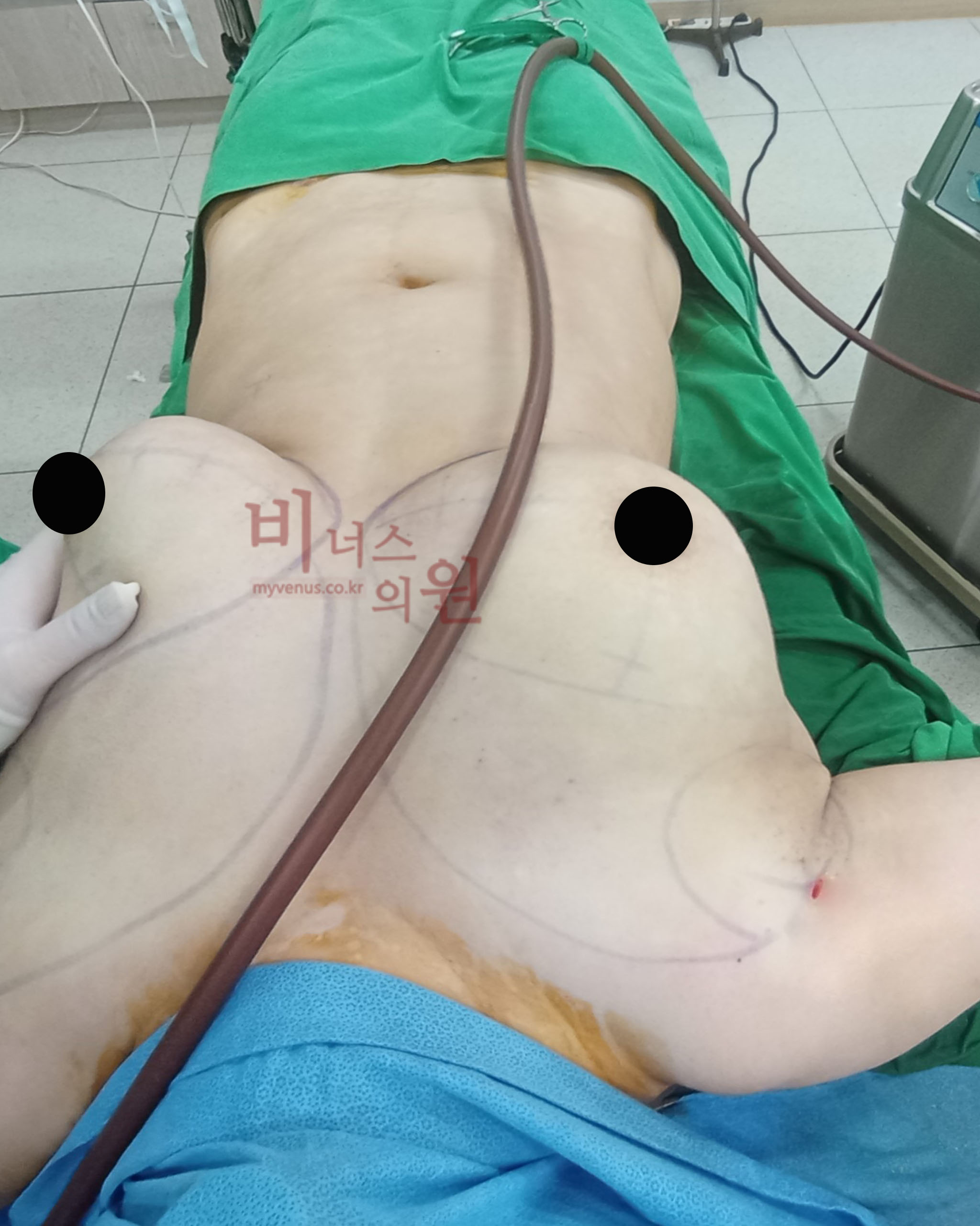 짝가슴 교정.jpg