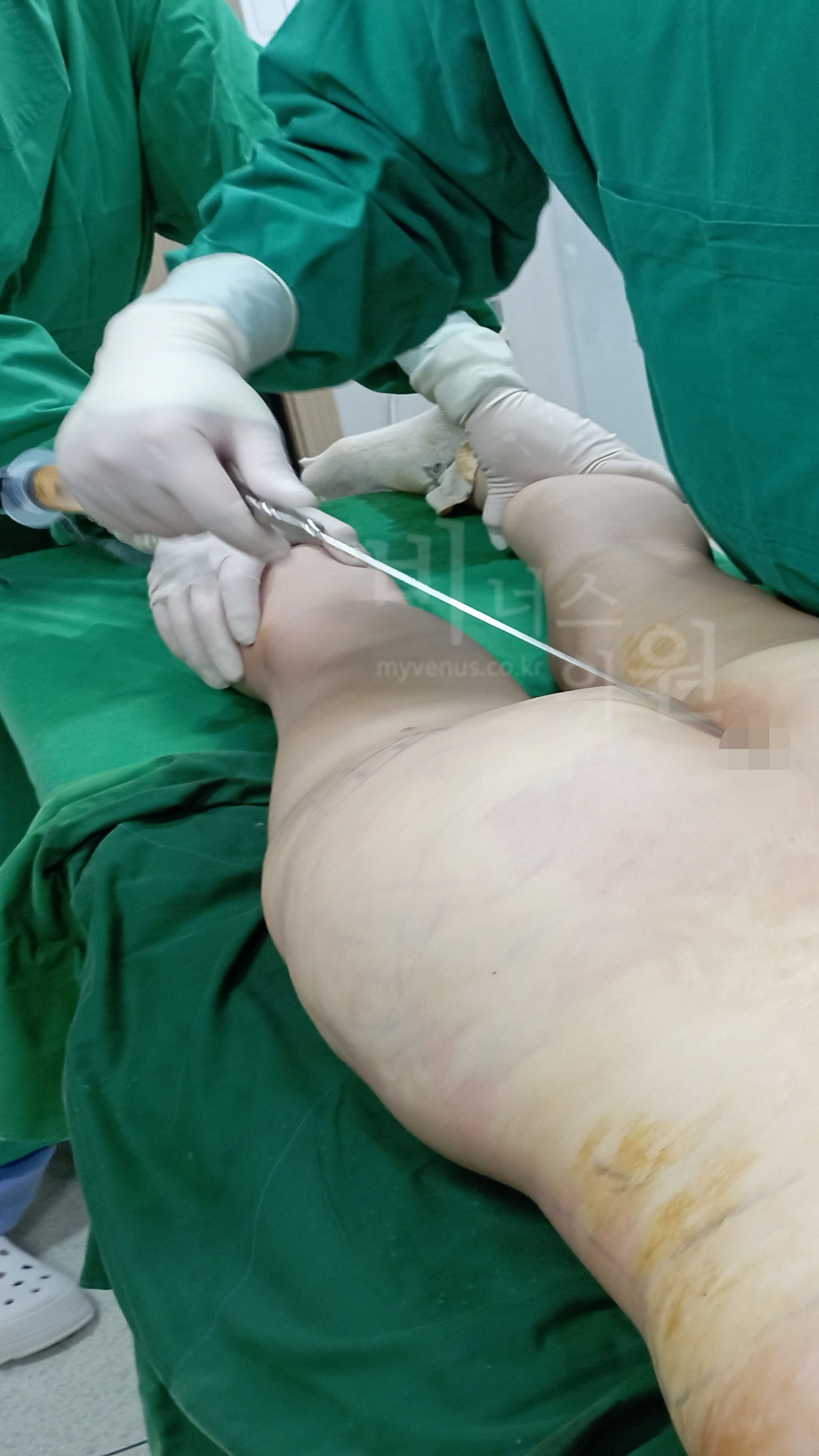 엉덩이 주름 지방이식.jpg