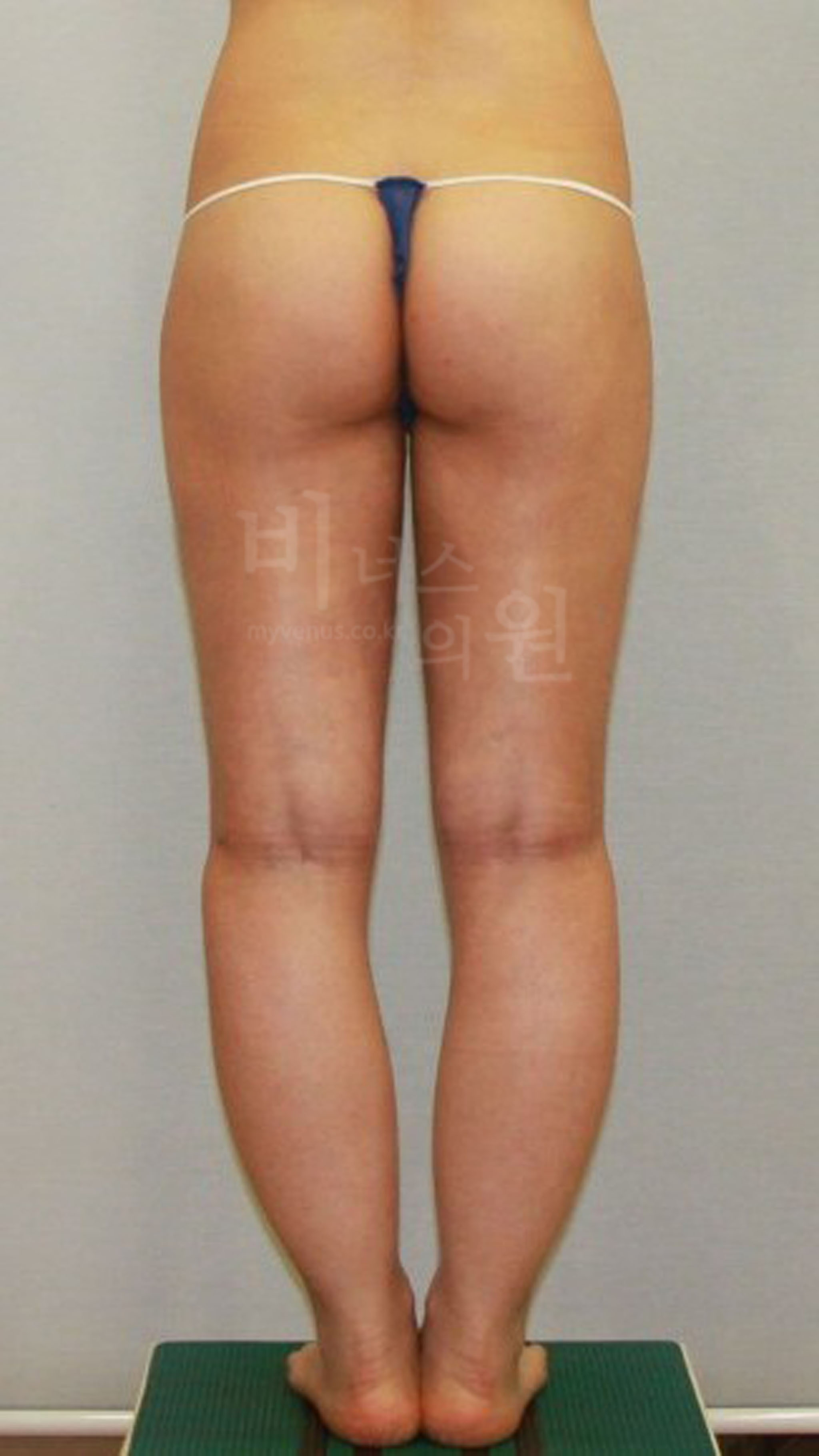 승마살 지방흡입.jpg