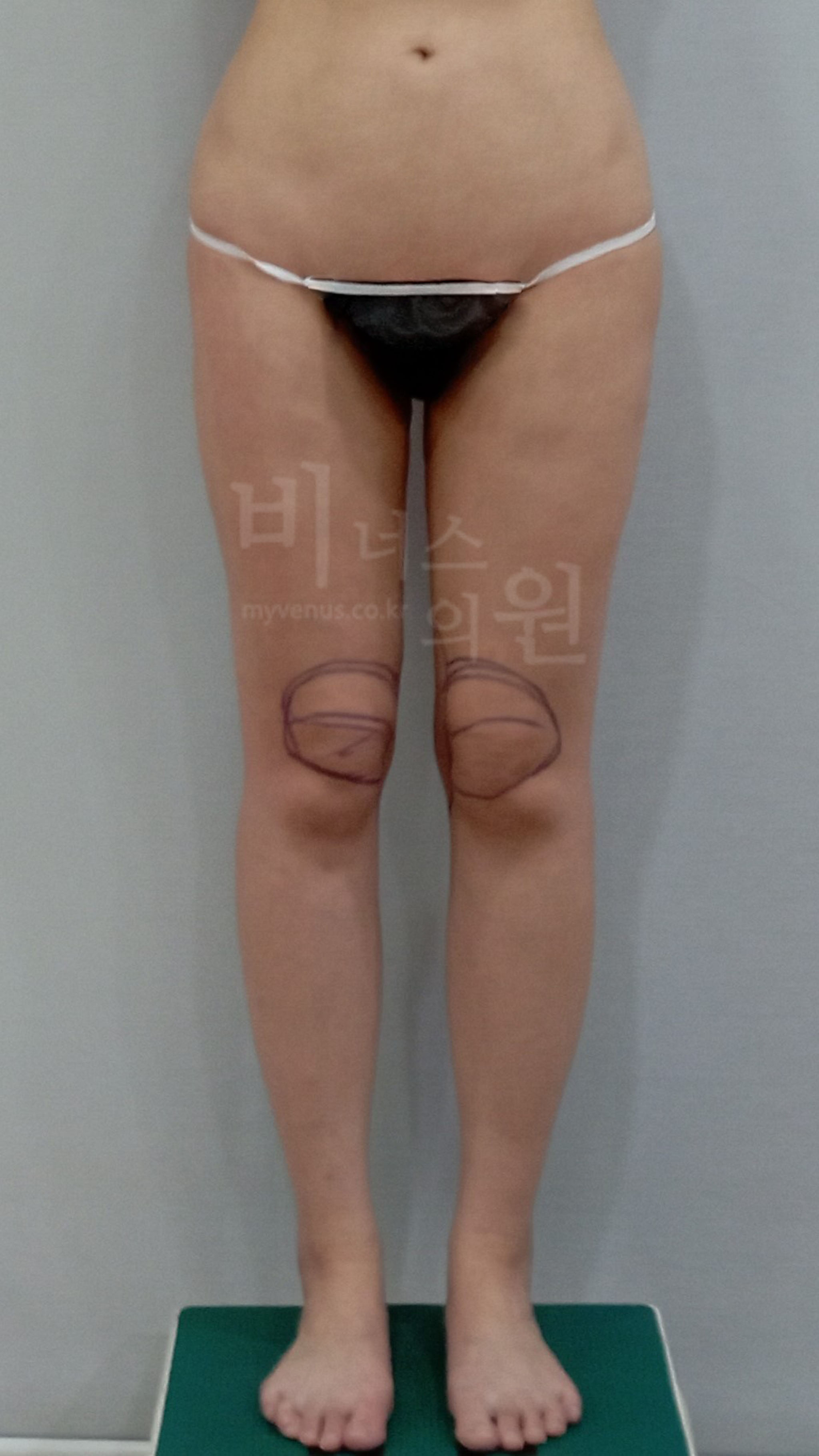 무릎 지방흡입.jpg